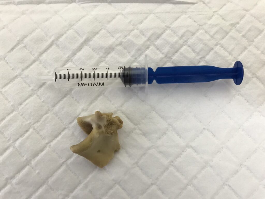 image-0-02-05-9ff9270f8922c07d37dcd7874247ed4cbdcaa42556074638fbb15452d6690f1e-V-1024x768 Эндоскопическое удаление инородных тел