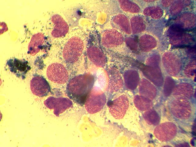 melanoma Цитологическое исследование