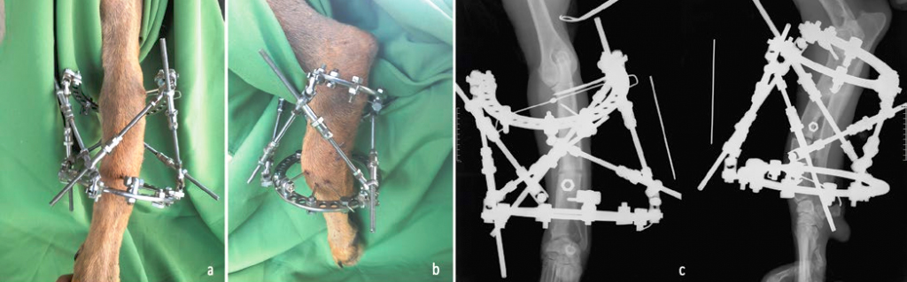 osteotomiya-luchevoy-kosti Диагностика и лечение синдрома укороченной лучевой кости