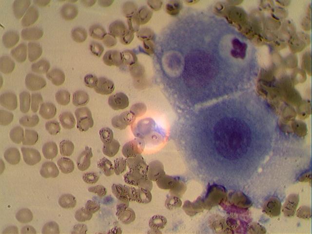 ploskokletochnyj-rak Цитологическое исследование