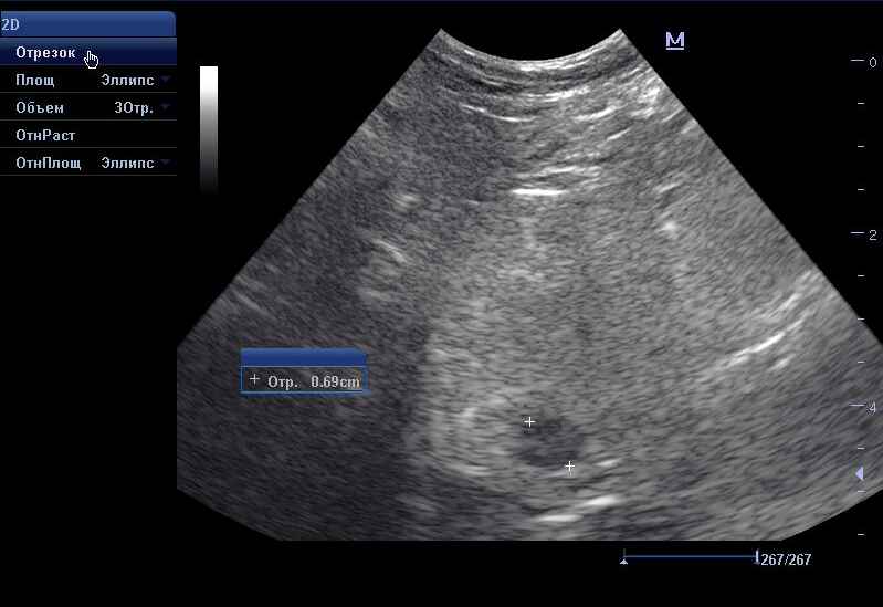 priznaki-prostatita-kista-predstatelnoj-zhelezy УЗ-исследование предстательной железы