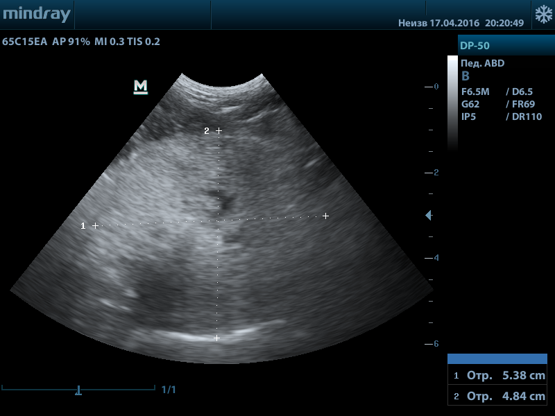 priznaki-prostatita УЗ-исследование предстательной железы