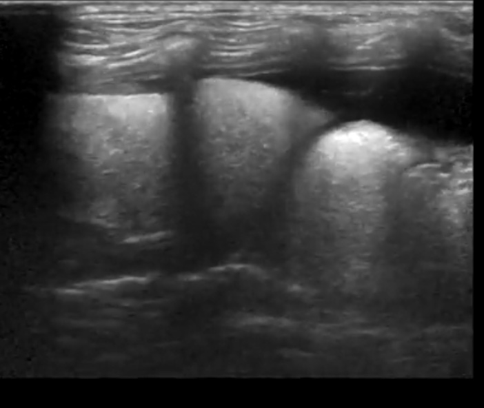 atelektaz-legkogo УЗ-исследование грудной полости