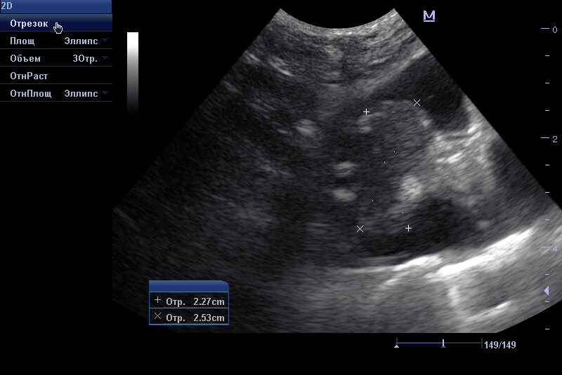 uchastki-fibroza-v-doli-pecheni УЗ-исследование грудной полости