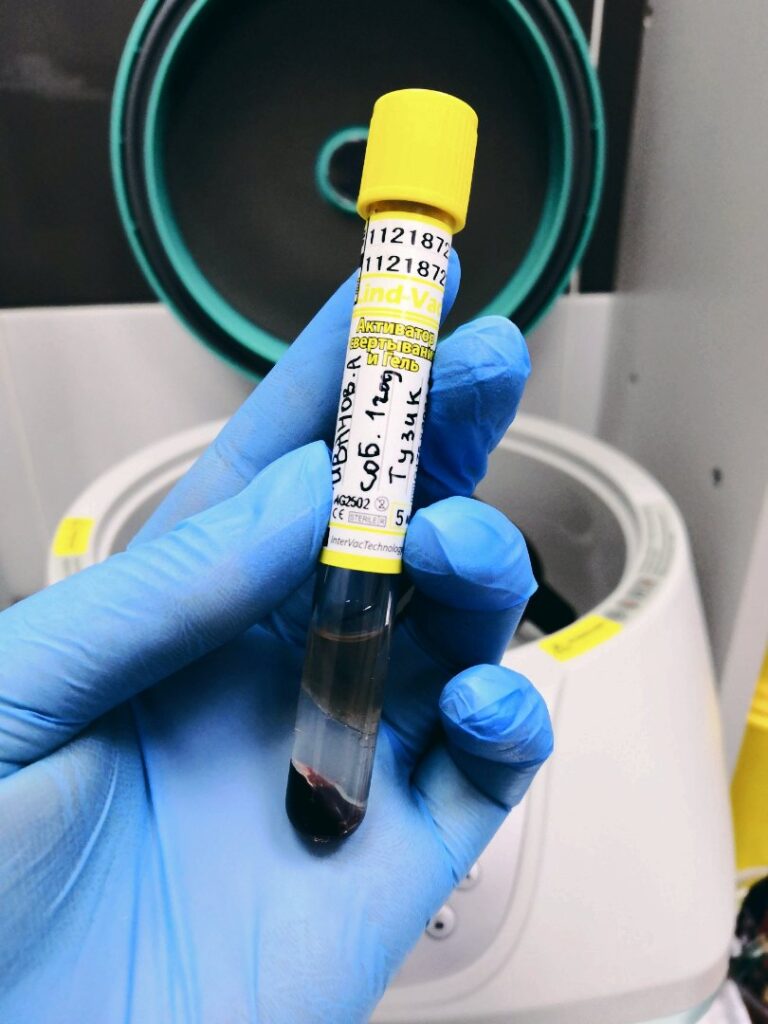 probirka-s-krovyu-dlya-biohimicheskogo-analiza-krovi-768x1024 Анализ крови биохимический