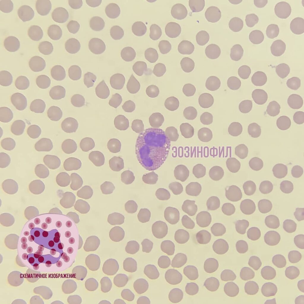 eozinofil-1024x1024 Общий анализ крови (ОАК). Лейкоциты
