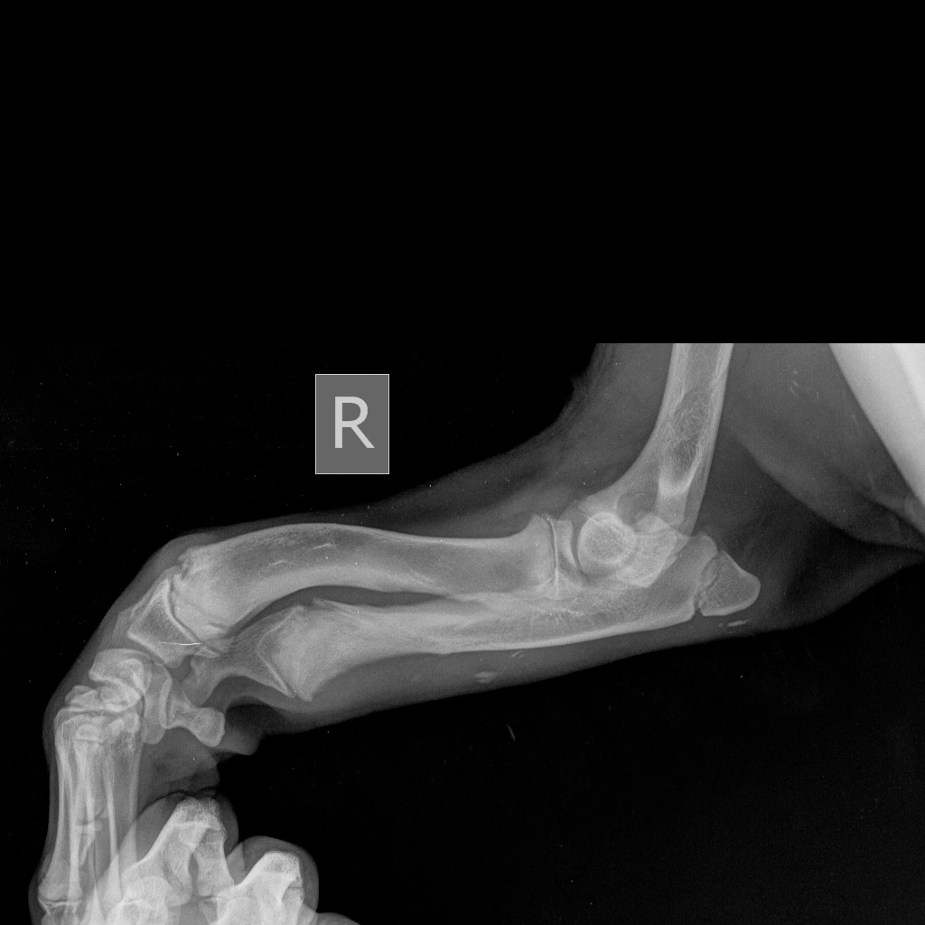 skelet-krupnyy-lapa Диагностика и лечение синдрома укороченной локтевой кости