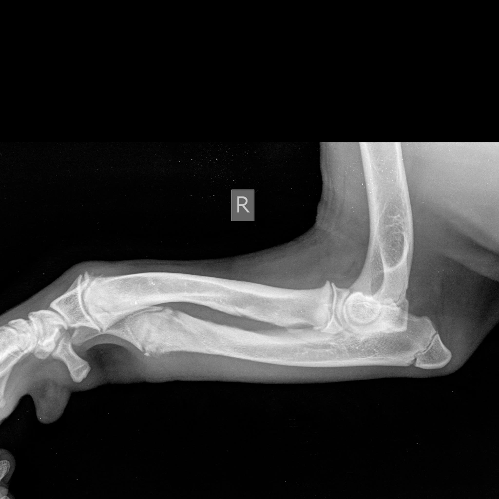 skelet-sredniy-lokot-snimok Диагностика и лечение синдрома укороченной локтевой кости