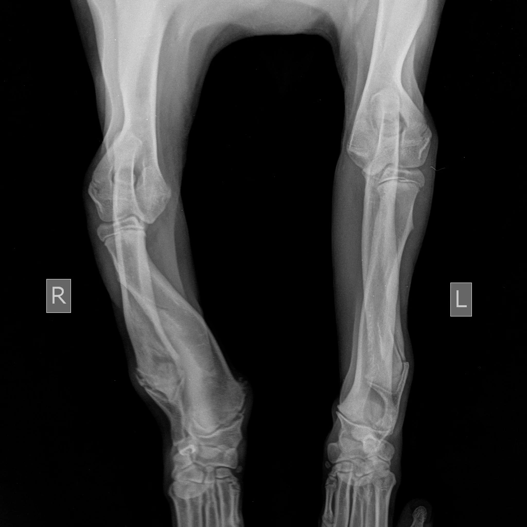 skelet-sredniy-lokot Диагностика и лечение синдрома укороченной локтевой кости