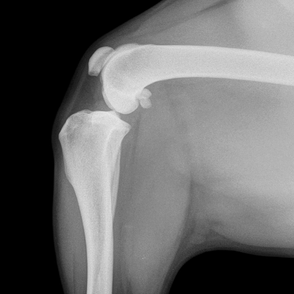 diagnostika-i-lechenie-razryva-pks-tplo_5 Диагностика и лечение разрыва ПКС, TPLO