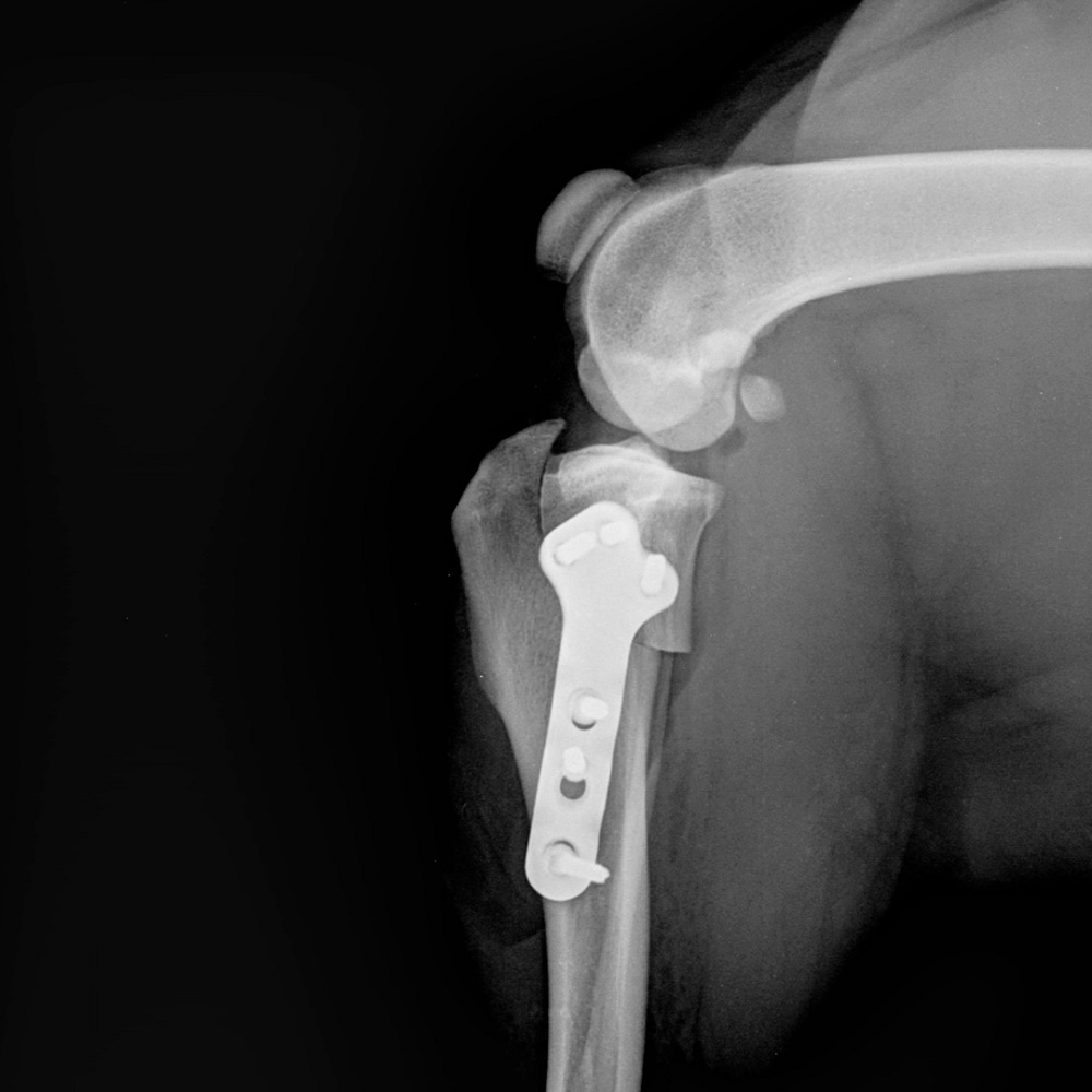 diagnostika-i-lechenie-razryva-pks-tplo_6 Диагностика и лечение разрыва ПКС, TPLO