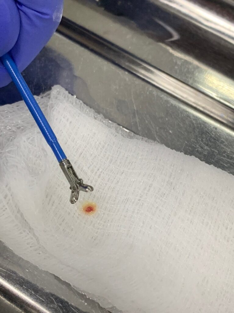 biopsiya-767x1024 Гастроскопия